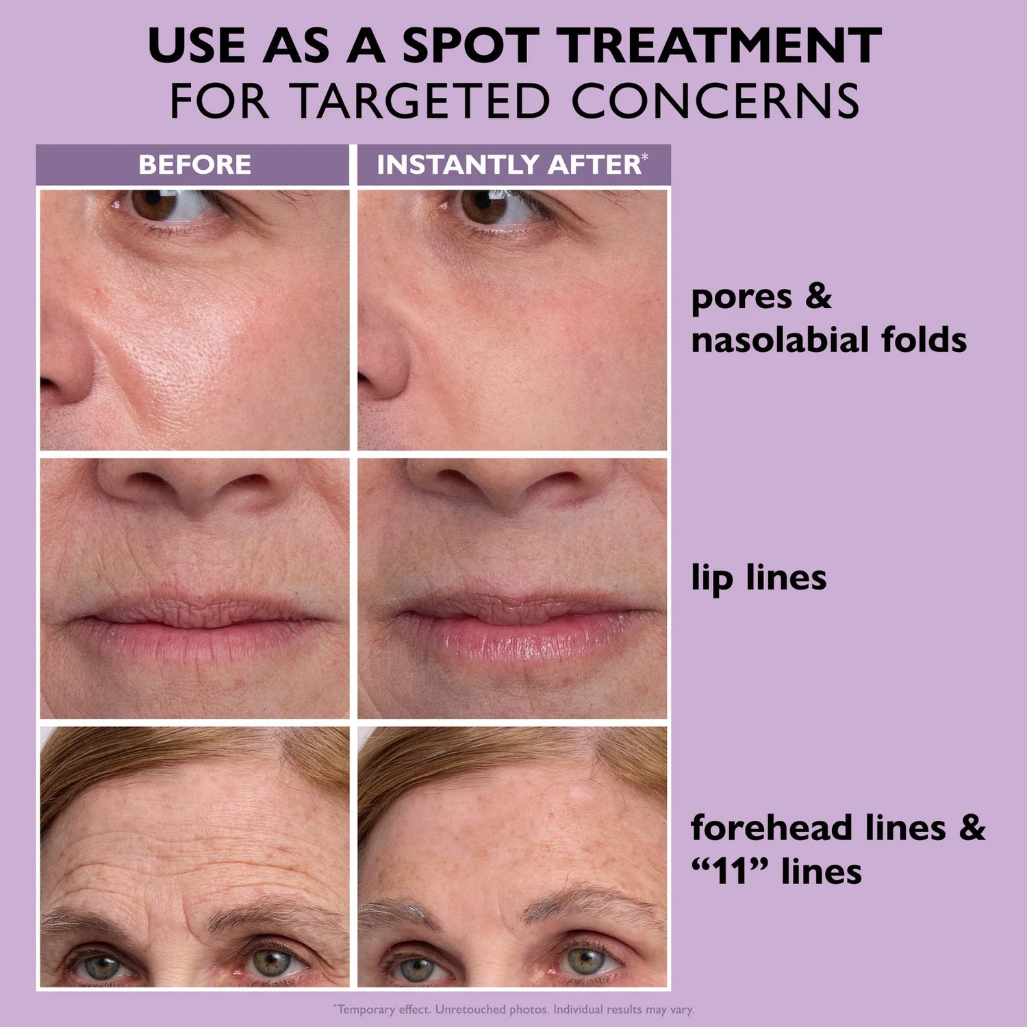 Targeted application for pores, lip lines and forehead lines