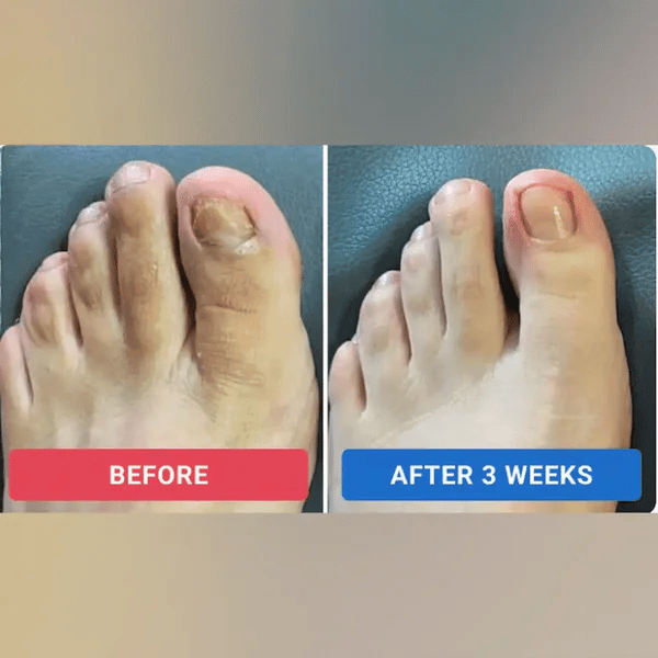 VAYVOVI Fungal Nail Patches