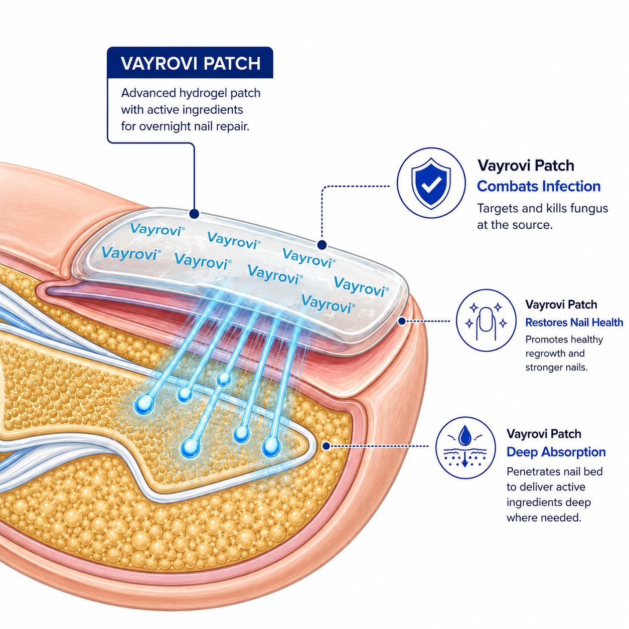 VAYVOVI Fungal Nail Patches