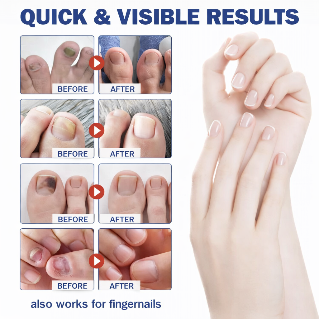 VAYVOVI Fungal Nail Patches